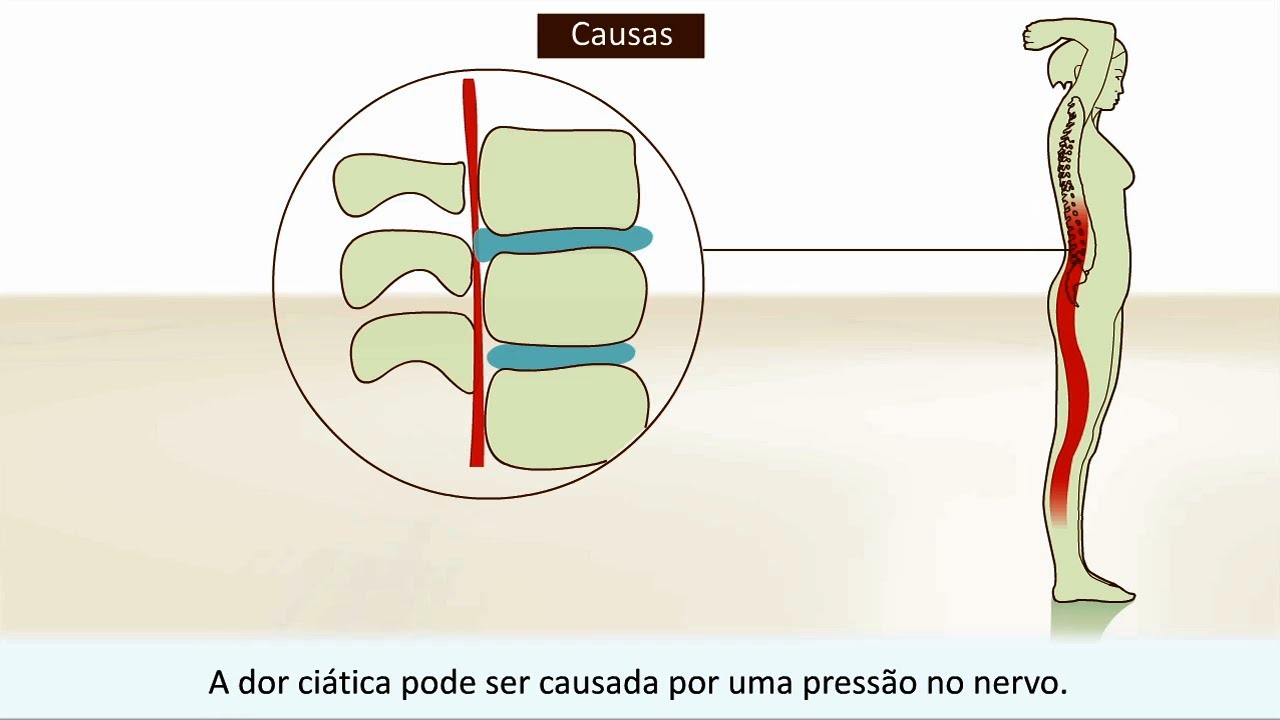 Ciática - O que é a dor ciática e como você pode tratá-la?