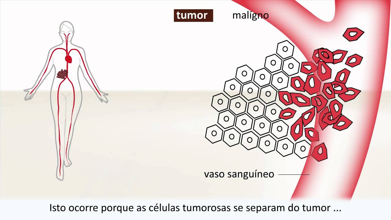 Câncer - Causa e tratamento