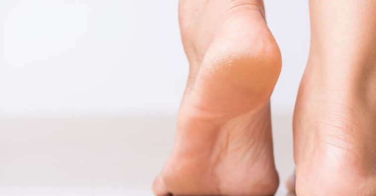 água oxigenada e aspirina para pés rachados