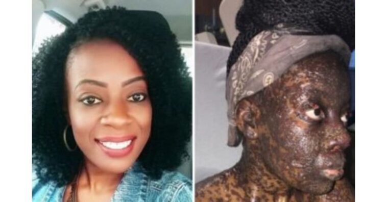 Antibiótico causa reação alérgica e mulher fica irreconhecível