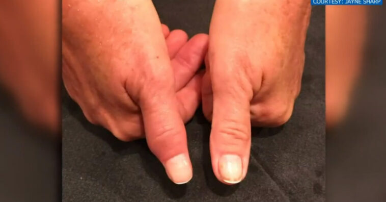 Bactéria comedora de carne em salão de beleza quase faz mulher perder o braço