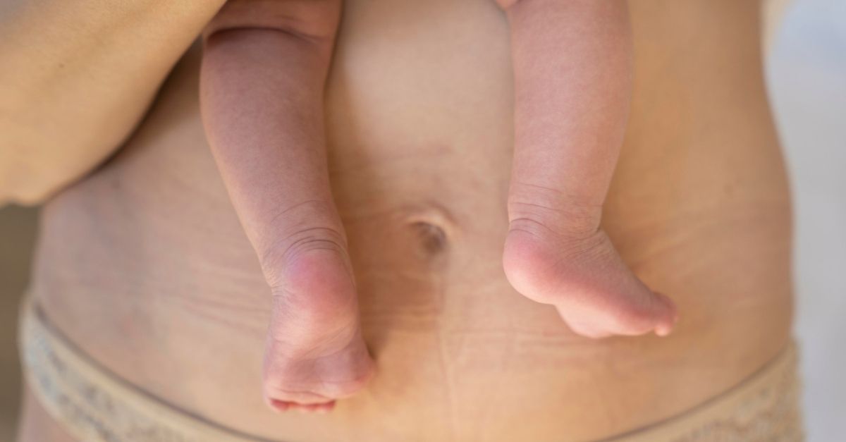 Barriga flácida após gravidez