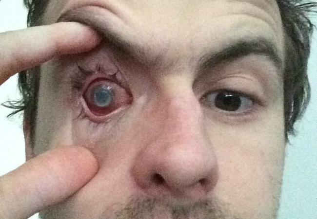 Cego de um olho por causa de parasita na córnea contaminação