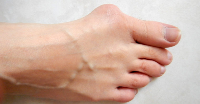 Como aliviar a dor nos joanetes