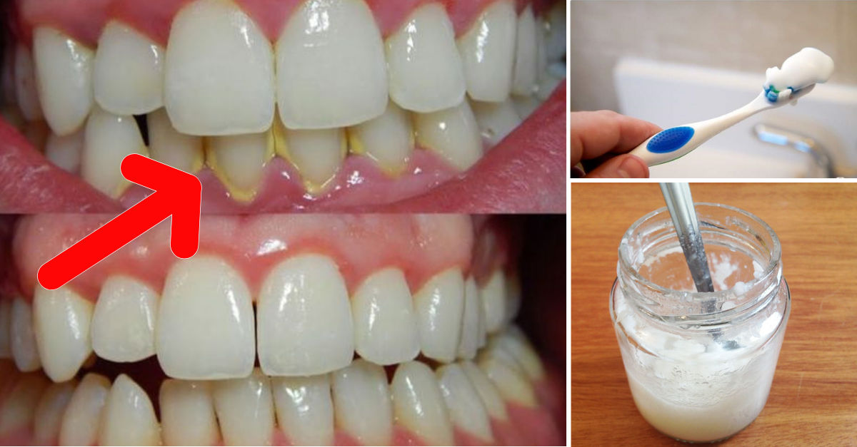 Como tirar tártaro dos dentes