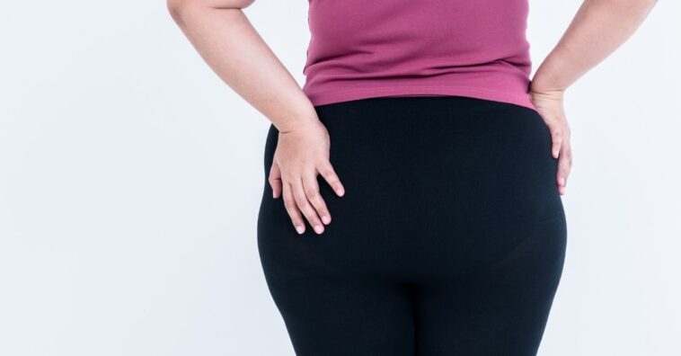 o que é lipedema