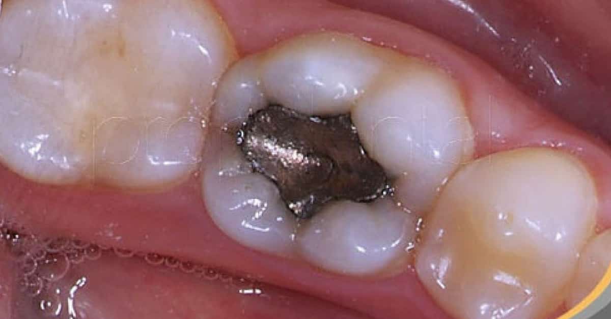 Você conhece os riscos que sua obturação de amálgama pode lhe trazer?