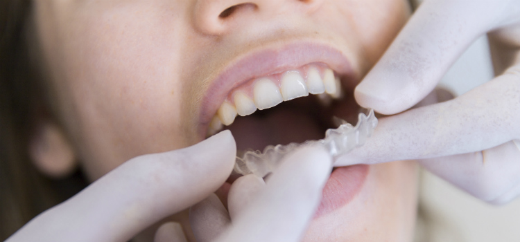 Dicas para manter os dentes brancos