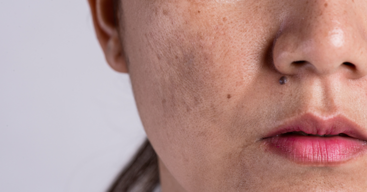 Dúvidas mais frequentes de quem sofre com melasma