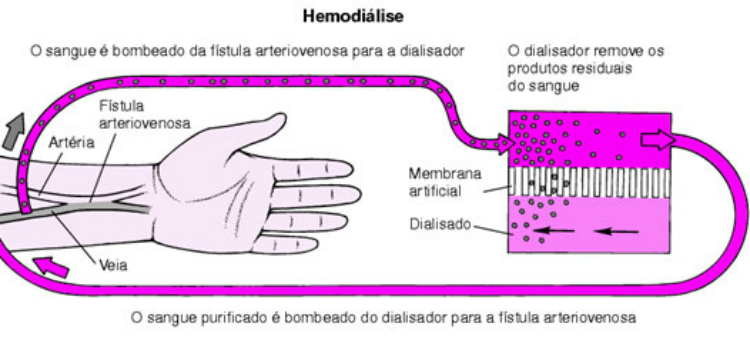 Hemodialise como funciona