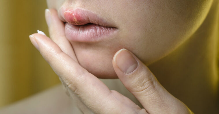 Herpes labial está relacionada à queda de imunidade