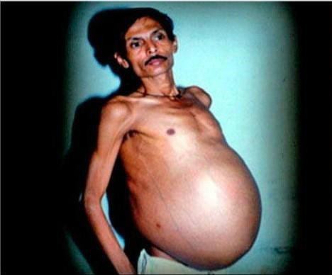 Homem grávido descobre que carregava feto de irmão gêmeo por 36 anos