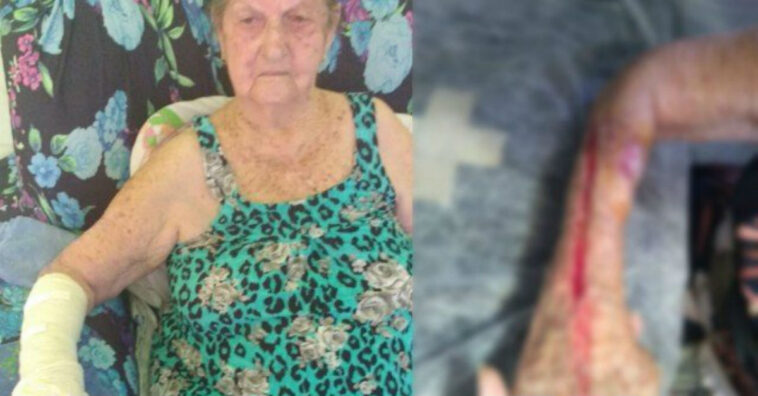 Idosa de 93 anos tem o braço cortado enquanto tirava gesso
