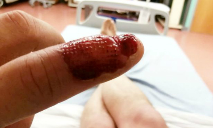 Infecção por roer as unhas