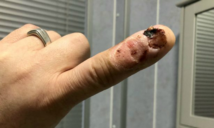 Infecção por roer as unhas homem quase morre