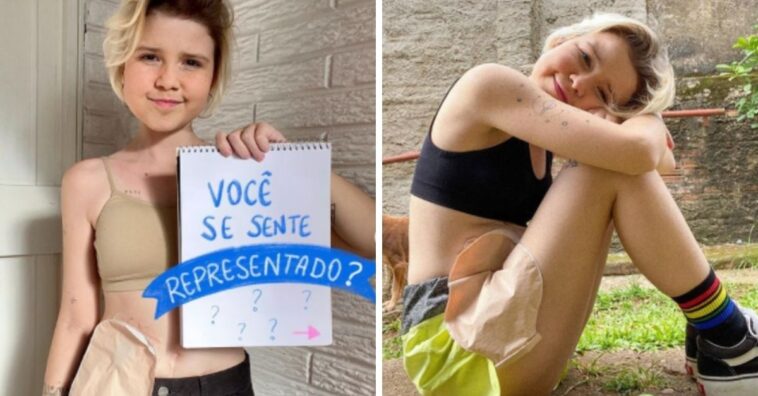 Influencer conta como conseguiu se aceitar com bolsa de colostomia