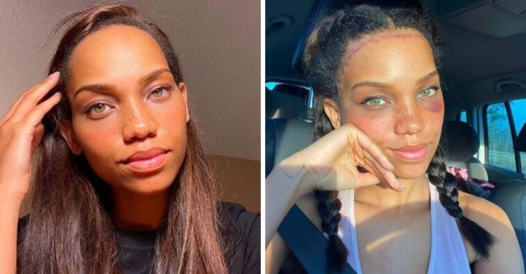 Influenciadora gasta R$ 39 mil em plástica para diminuir a testa