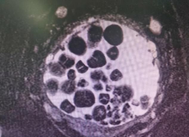 Médicos retiram 100 pedras da bexiga de idoso