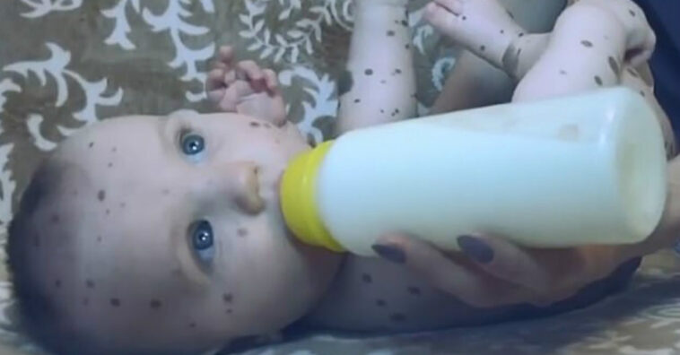 Mãe de bebê com marca de nascença recebe comentário de ódio