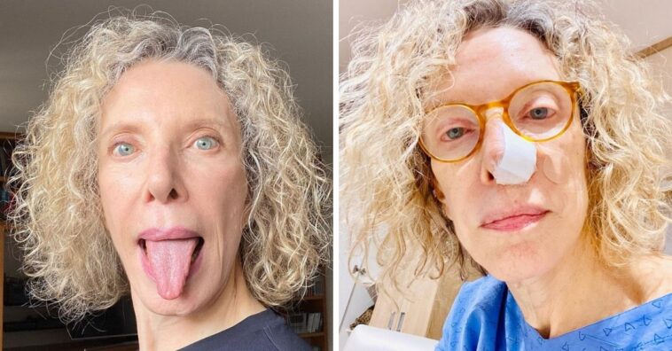 Marília Gabriela descobre câncer de pele no nariz