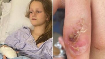 Menina de 9 anos quase morre depois de mordida de hamster