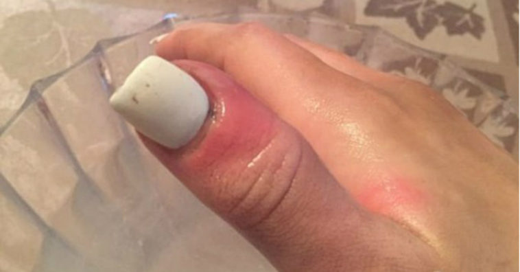 Modelo americana desenvolve câncer embaixo de unha de gel