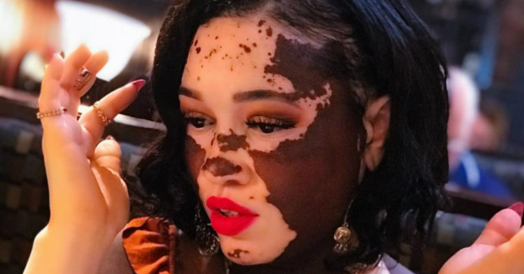 Modelo com vitiligo revela ter sofrido racismo