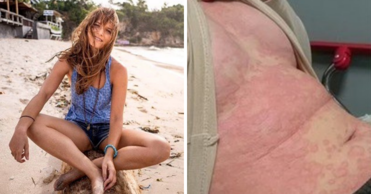 Mulher com estresse alérgico agora só trabalha para ganhar o suficiente e viajar de férias