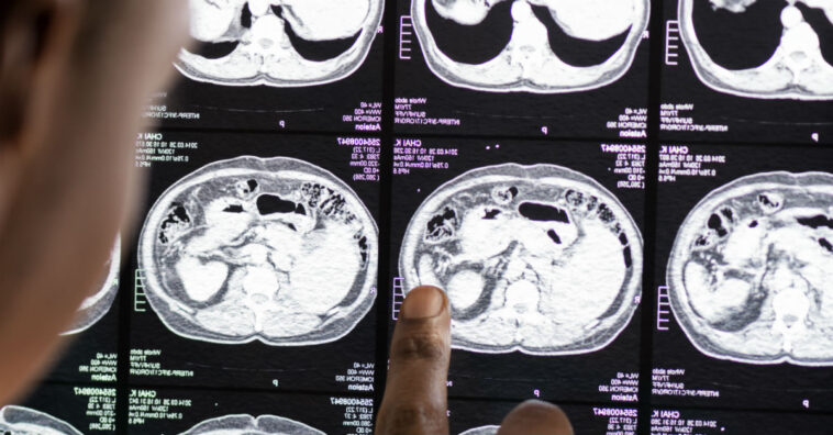 Mulher viveu até a idade adulta com seu gêmeo parasita no abdome