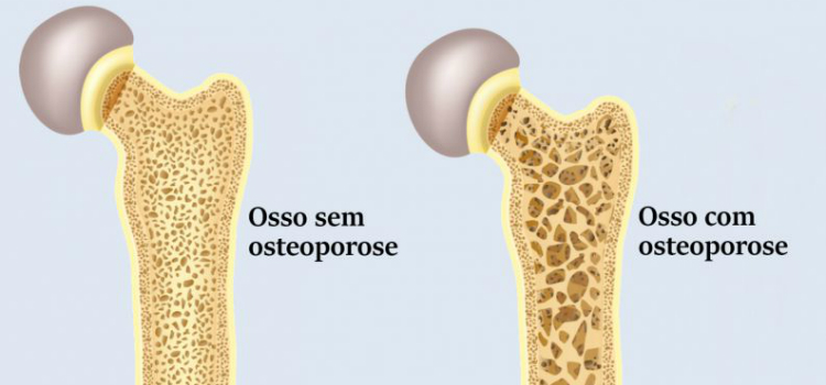 Osteoporose sintomas