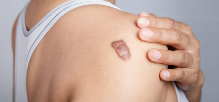 Queloide que médico consultar