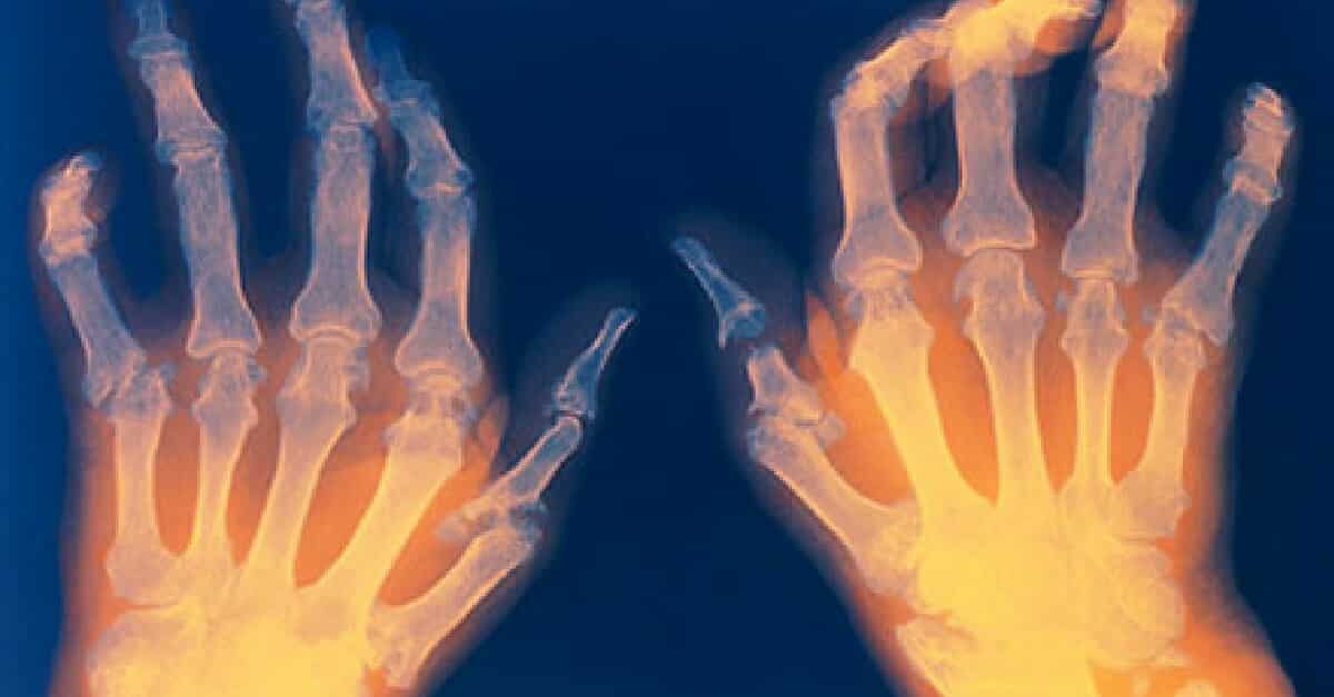 dores nas articulações