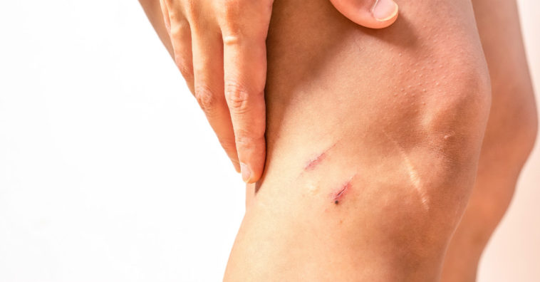 acelerar a cicatrização