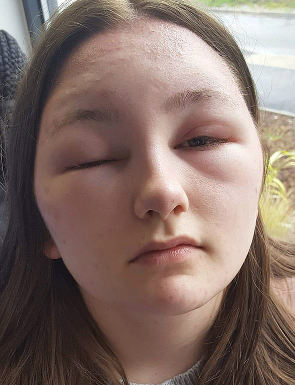 adolescente fica cega por dois dias queimadura
