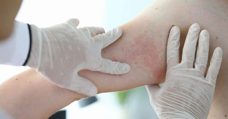 alergia emocional braço com vermelhidão sintomas