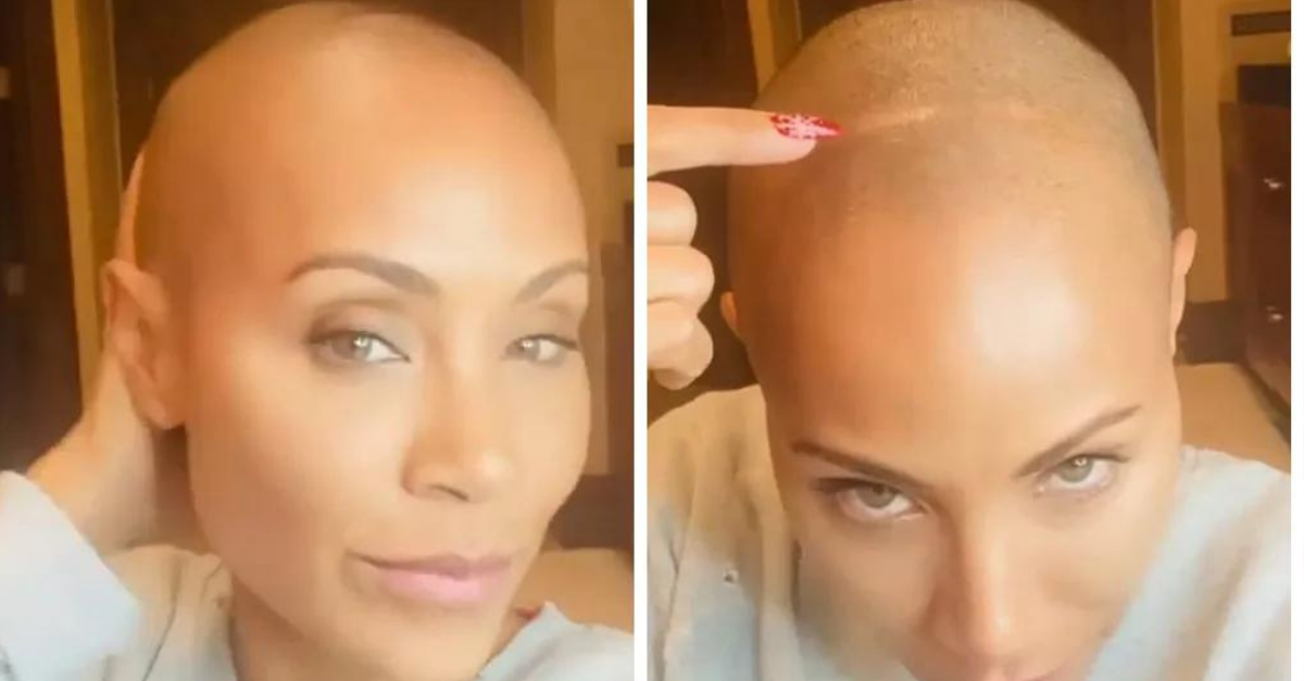 Tipos de alopecia, uma condição que leva à queda de cabelo