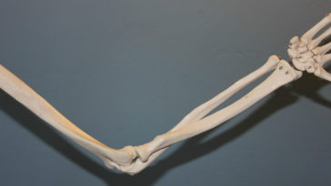 alviar dor da artrite naturalmente