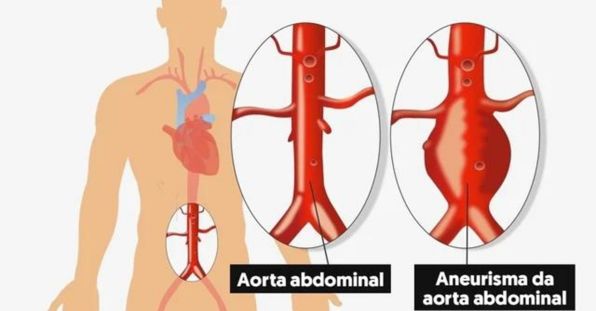 Aneurisma de aorta: saiba o que é, sintomas e tratamentos
