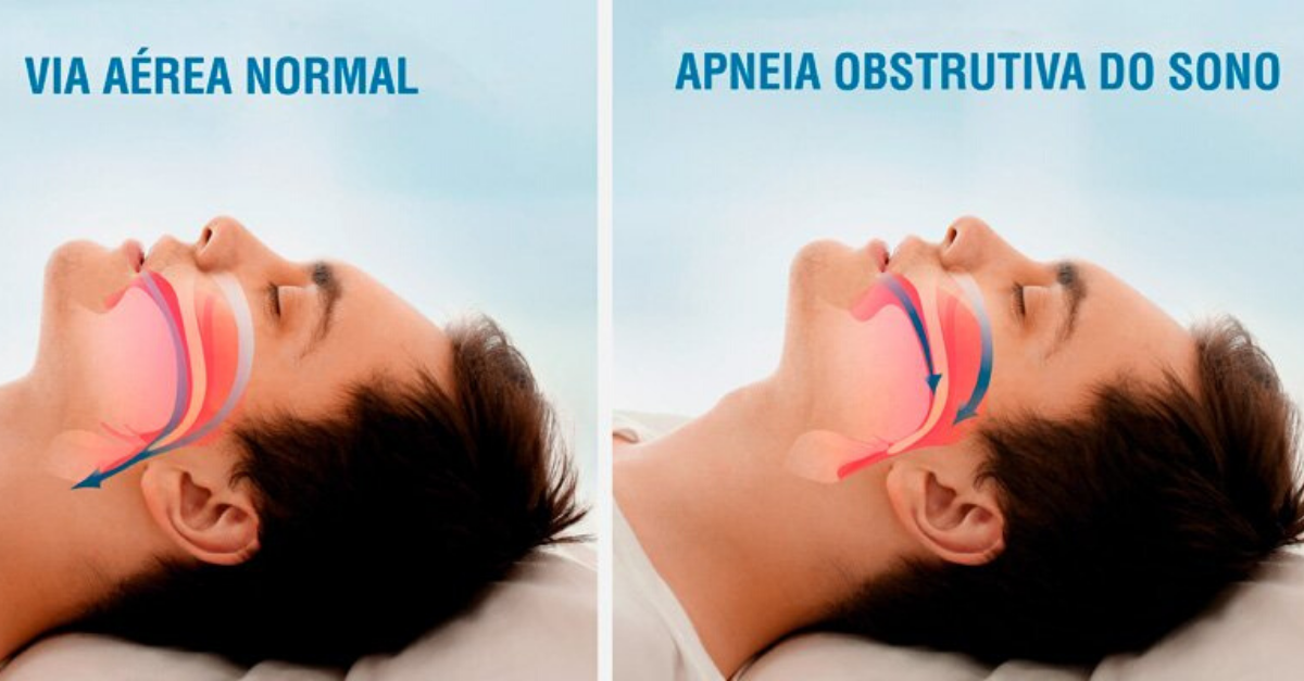 Apneia do sono: tudo o que você precisa saber