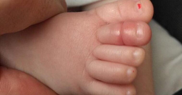 bebê quase perde dedo por causa de fio de cabelo