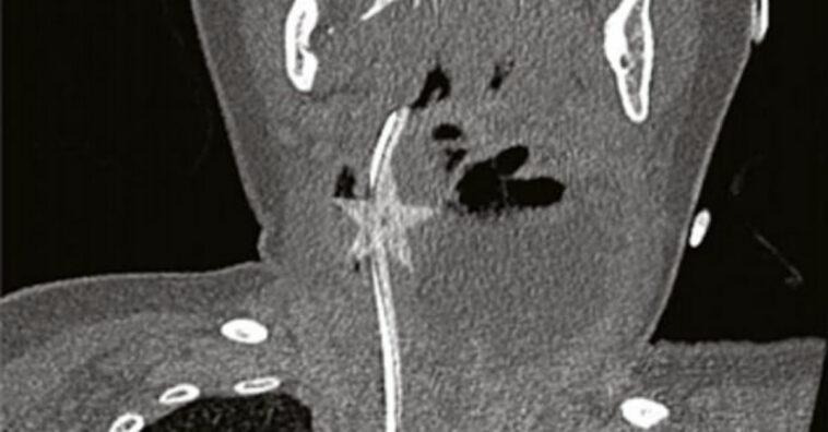 bebê engole estrela de natal