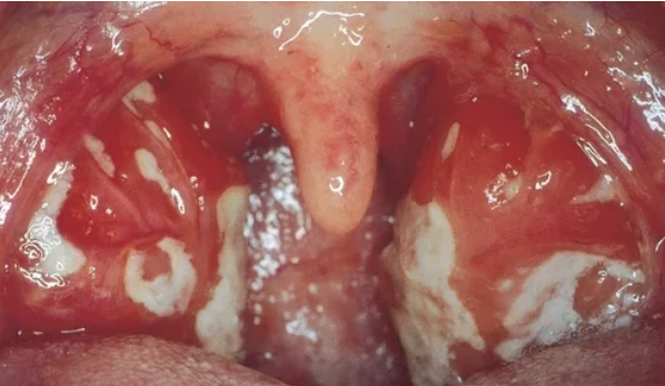 mononucleose