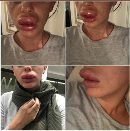 botox nos lábios deu errado