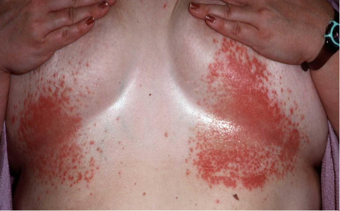 candidíase cutânea