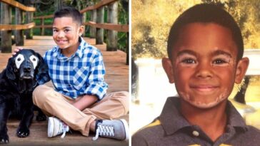 carter e rowdy com vitiligo