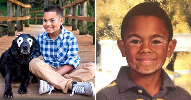 carter e rowdy com vitiligo