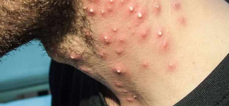 casos de foliculite no rosto