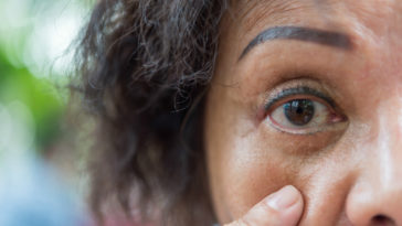 casos de herpes-zóster em idosos