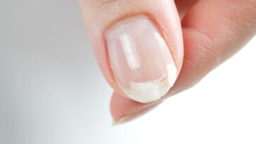 Unhas descamando o que pode ser