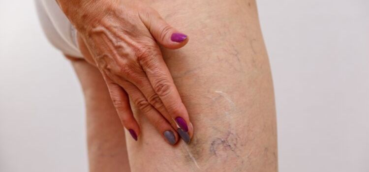 principais causas má circulação nas pernas